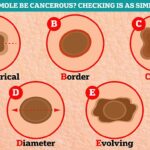 Could YOUR mole be cancerous? After warning that over 20,000 Brits could get skin cancer this year we reveal the simple ABCDE guide that doctors use to spot melanoma
