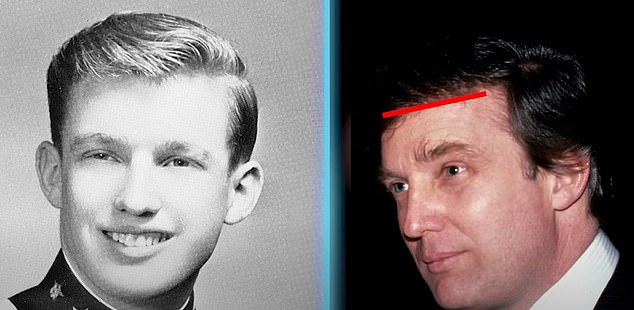 Dr. Linkov also said that in 1978, at age 32 (right), 'the appearance of Donald Trump's hairline has changed significantly compared to when he was 18 (right). The hairline is much straighter, it's lower and it looks less natural.'