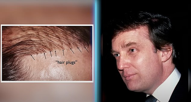 Dr. Linkov also believes Trump had a plug graft, a type of hair transplant surgery in which surgeons take hair from the back of the head and transplant it to bald spots
