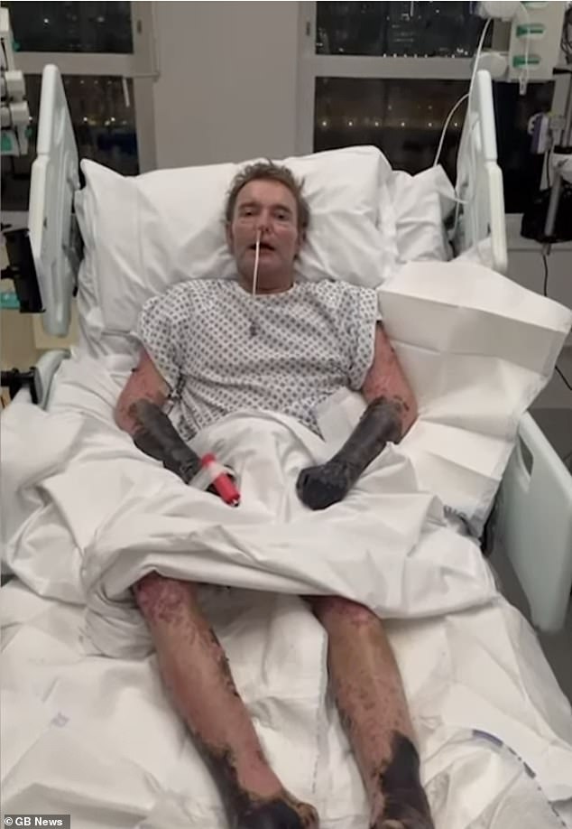 Craig Mackinlay was seen with blackened limbs after suffering from sepsis at St Thomas' Hospital on November 30