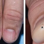 How a long white line on your finger nail could mean you’re at a much higher risk of kidney CANCER