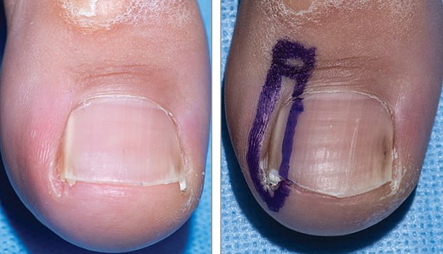 Of all people with cancer-sensitive syndrome, 88 percent had tumors on their nails