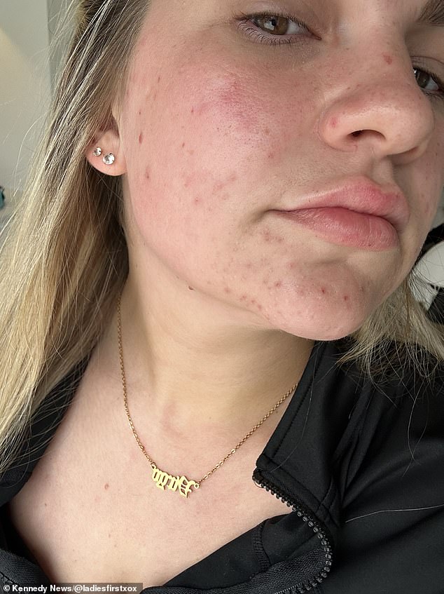 She said: 'I started getting acne on the coils too and it's not a problem I've ever had before.'  After begging her doctor to remove the IUD again in April, she agreed but told Ms Platt she needed to book an appointment, she claimed