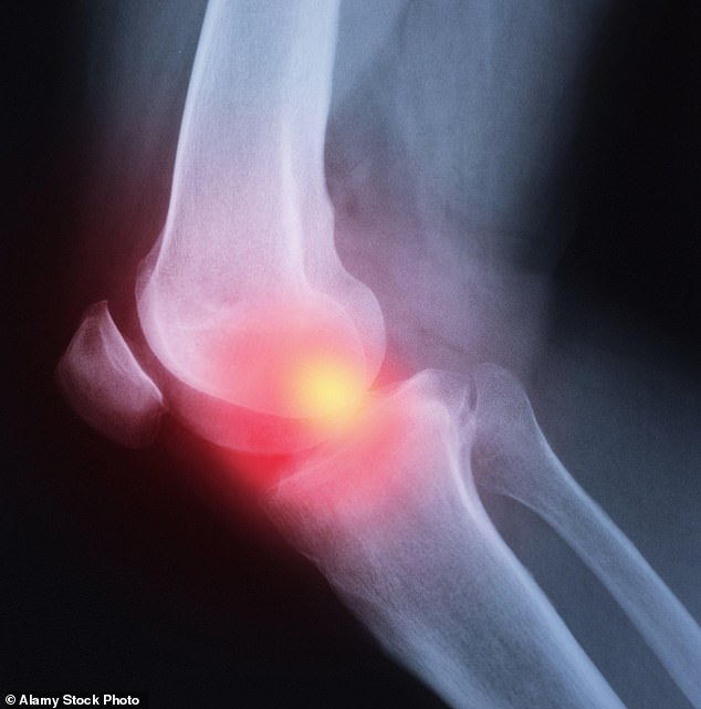 Rheumatoid arthritis occurs when the immune system attacks healthy tissue surrounding the joints - usually the hands, feet or wrists - causing inflammation, swelling and stiffness
