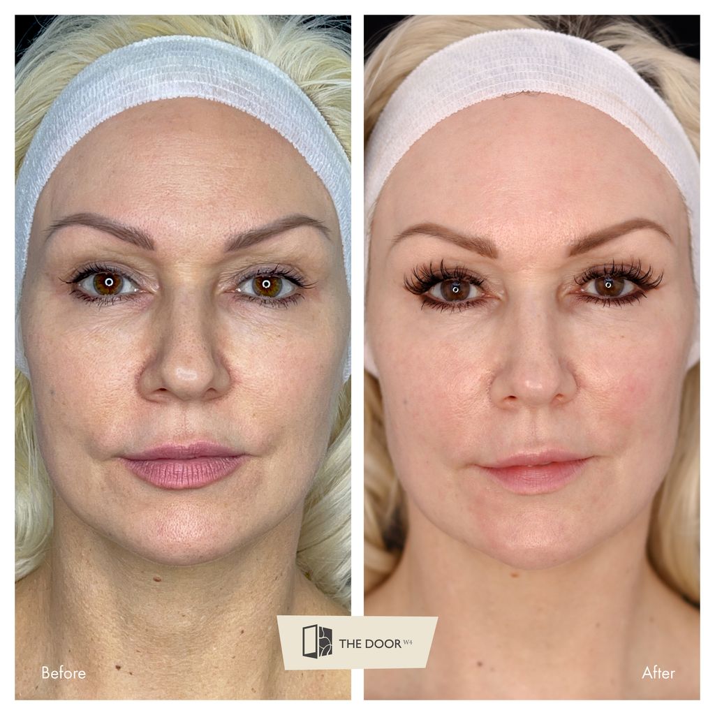 Kristina Rihanoff before and after her skin treatment