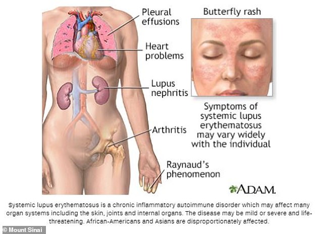Symptoms of lupus include pleural effusion (fluid buildup in the lungs), heart and kidney problems, arthritis and Raynaud's phenomenon (when fingers turn white or blue due to stress or cold). A butterfly-shaped rash on the face is also a major symptom