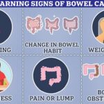 I’m a bowel cancer expert, here are five reasons the disease is becoming more common in under 50’s