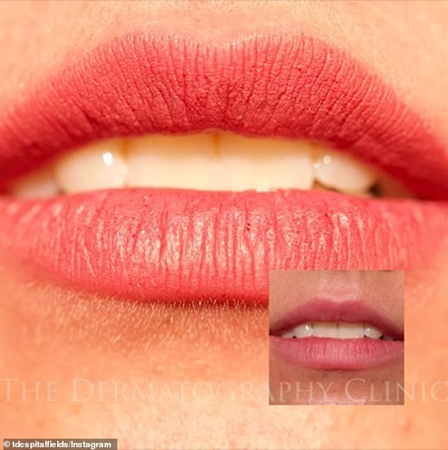 Photo of a woman's lips after receiving permanent full-lip contouring at a dermatology clinic in London