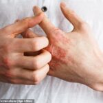 A shocking one in 10 Americans get eczema – scientists say they’ve found surprising culprit in our food
