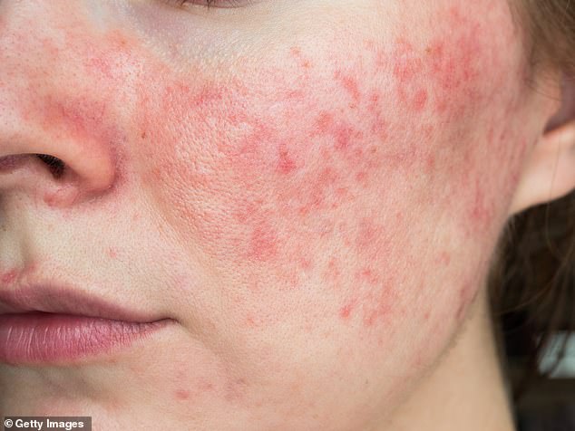 DR MARTIN SCURR: The medicines that really can calm spotty skin and how your mood may make it worse