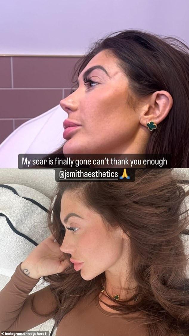 She posted a comparison photo showing her smooth skin side by side, and expressed her gratitude to the clinic that treated her skin, writing: 'My scar is finally gone I can't thank you enough.'