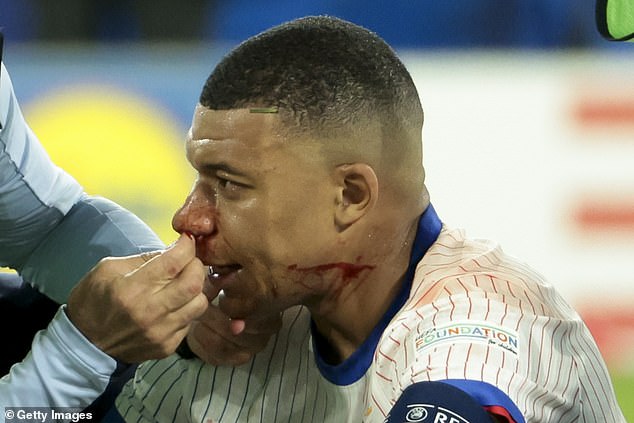 Kylian Mbappe’s broken nose: Plastic surgeons say star striker may need surgery in coming weeks to avoid permanent changes to his face