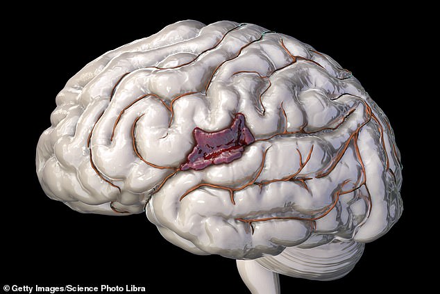 An intracranial haematoma, or collection of blood within the skull, can cause patients to zone out suddenly and is usually brought on by a burst blood vessel