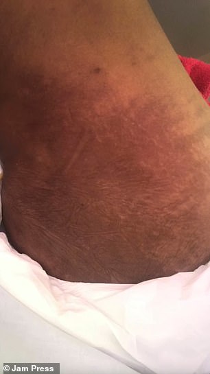 It is unclear what exactly Ms da Silva had done, although there are very few approved and effective treatments for cellulite