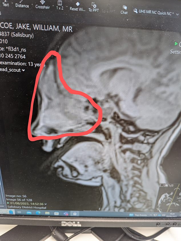 A CT scan revealed Jake had an egg-sized growth inside his skull that was pressing on his brain, causing symptoms such as a fever.