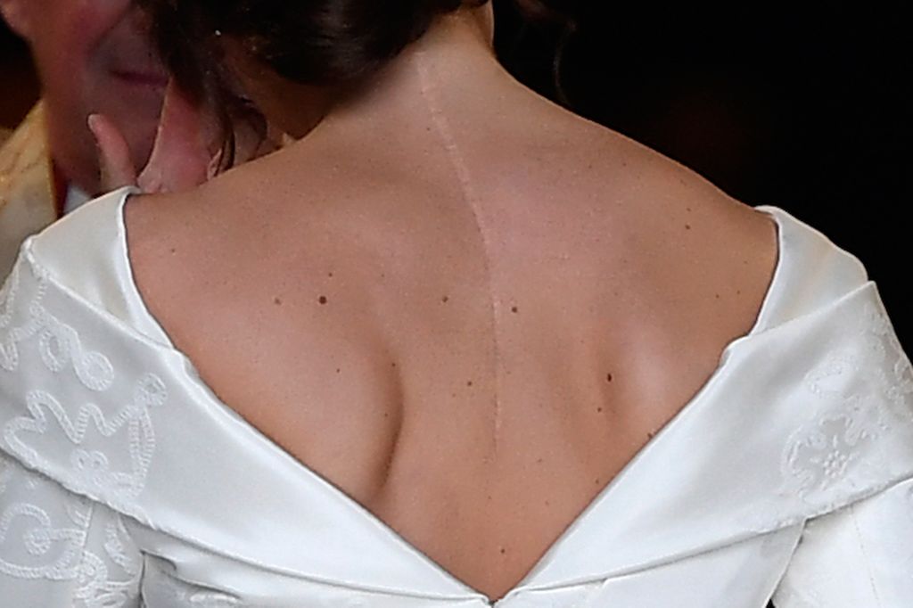 Princess Eugenie has a surgery scar on her back