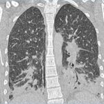 86836999 13592971 The scan of the patient s lungs reveal semi opaque spots that do m 12 171993634128